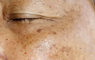 你不知道的祛斑消痘印小竅門，方便又省錢