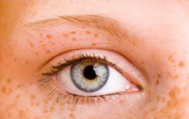 女人黃褐斑是怎么形成的？主要與這幾大因素有關