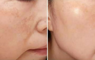 都說祛斑難，對不起，那是他因為你沒選對方法！